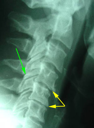 disc degeneration treated at Minster Chiropractic Center