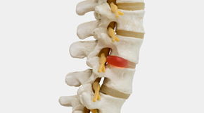 Minster chiropractic conservative care helps even giant disc herniations go away