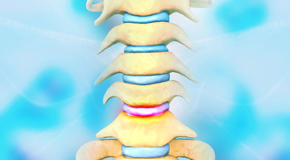 Minster disc degeneration health
