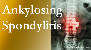 Ankylosing spondylitis is gently cared for by your Minster chiropractor.