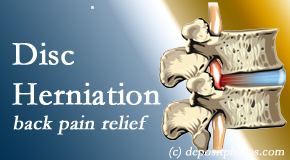 Minster Chiropractic Center uses non-surgical treatment for relief of disc herniation related back pain. 