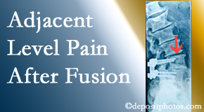 Minster Chiropractic Center offers relieving care non-surgically to back pain patients experiencing adjacent level pain after spinal fusion surgery.