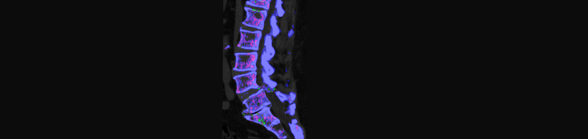 Minster Chiropractic Center is aware that inflammatory spinal gout is a differential diagnosis to consider for patients who present with back pain and other spine related symptoms.