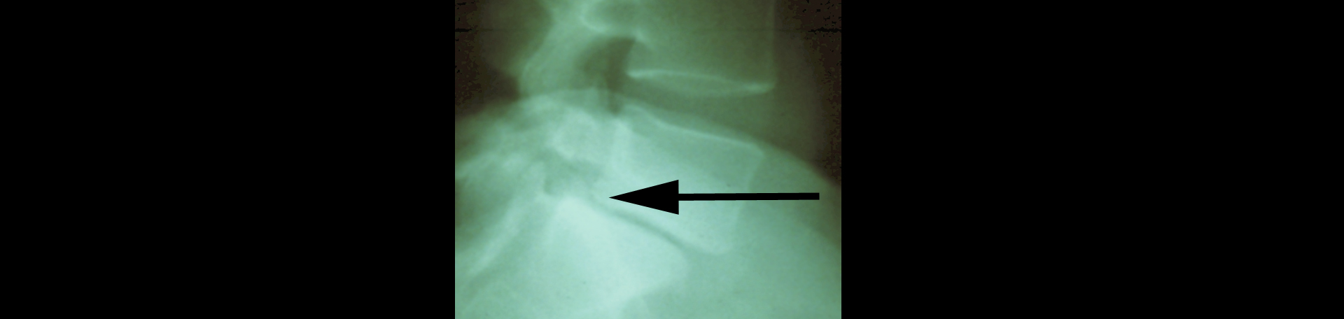 Minster spondylolisthesis 