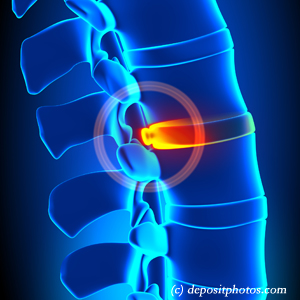 picture of lumbar Minster disc herniation