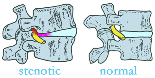 Minster stenotic and normal spinal discs