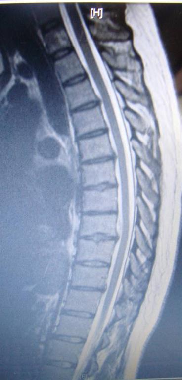 Chiropractic Care Of The Thoracic Spine Contained Disc | Minster  Chiropractic Center